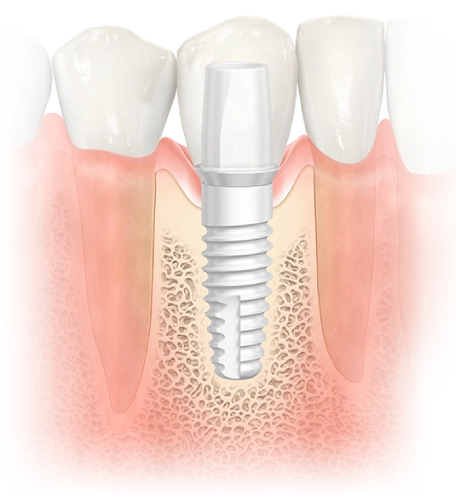 implantes-ziconio-comparativa-titanio