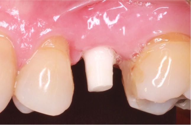 implantes-zirconio-beneficios