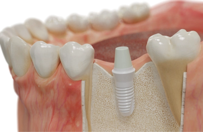 implantes-zirconio-que-son