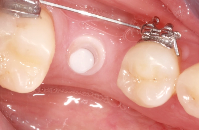 implantes-zirconio-ventajas-salud-estetica-dental